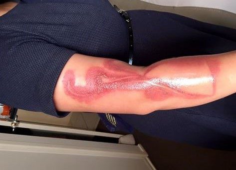 iPhone 7 esplode: ustioni di 2° grado per una giovane donna incinta